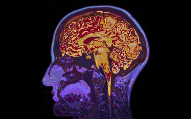 New tool means a single MRI scan can be used to estimate Pace of Aging